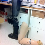 Before and After: Right is 30 year old prosthetic exoskeltal limb. Left, new high activity above knee prosthesis.