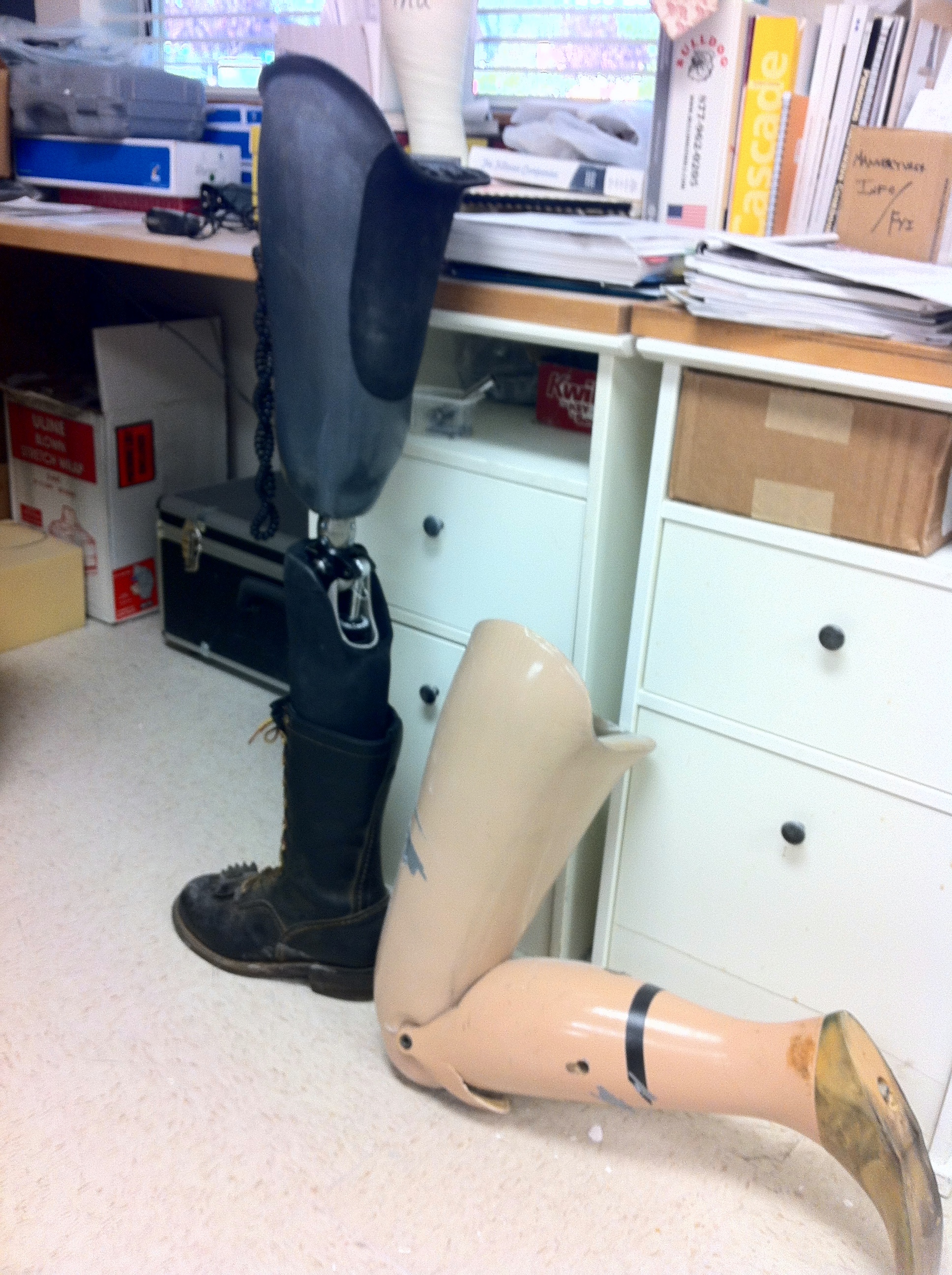 Before and after: Right is 30 year old prosthetic exoskeltal limb. Left ...