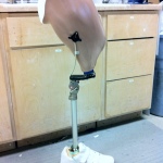Above knee prosthesis with special alignment for hemiplegic individual. Created by practitioner Dann Goodnough